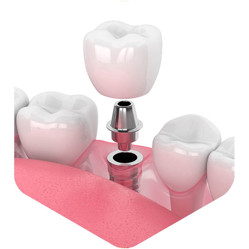 Illustration of dental implant